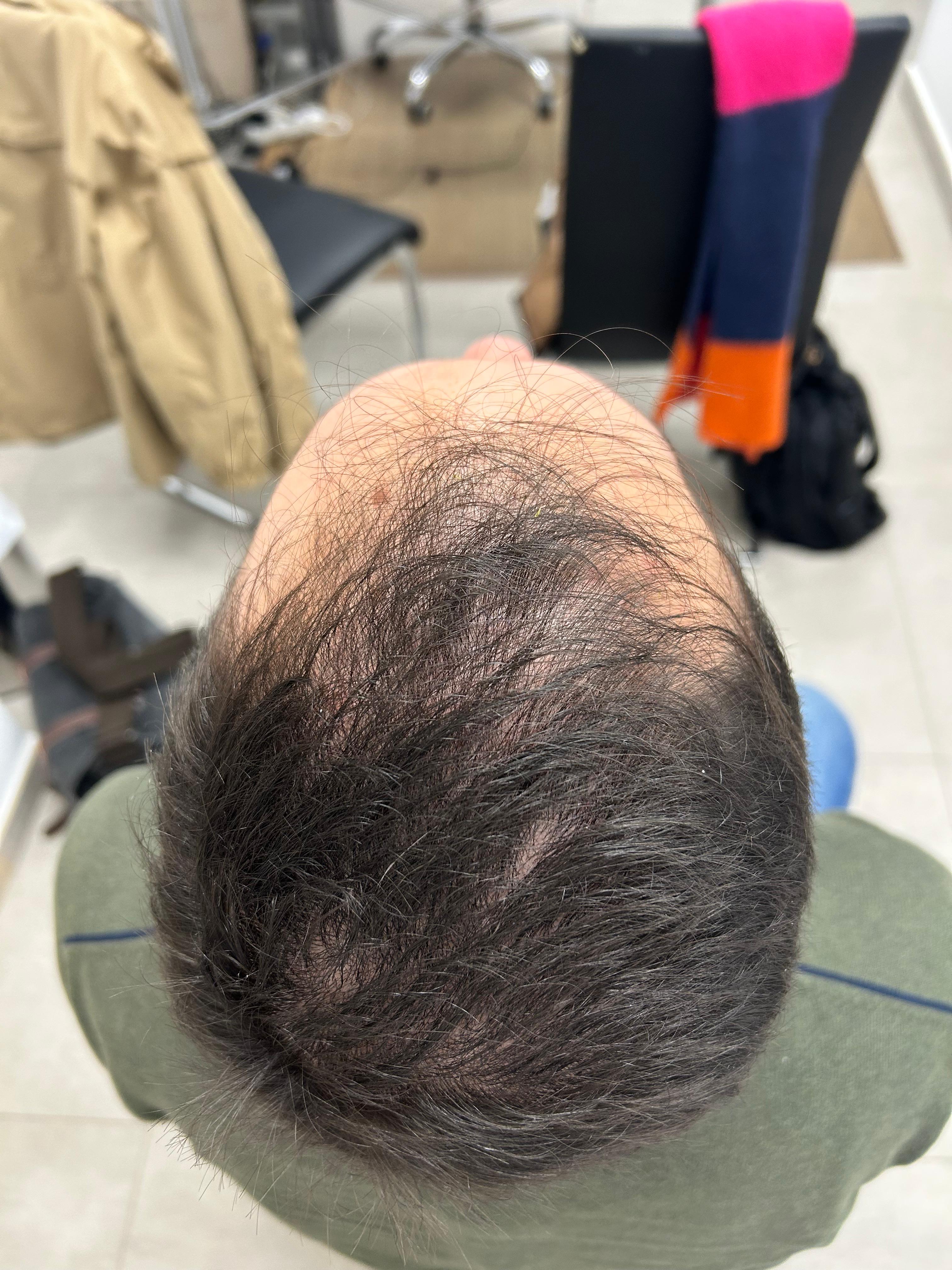 Antes del tratamiento · Caso 1